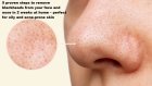5 proven steps to remove blackheads from your face and nose in 2 weeks at home – perfect for oily and acne-prone skin