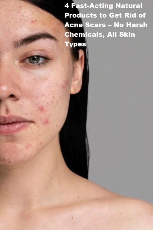 4 Fast-Acting Natural Products to Get Rid of Acne Scars – No Harsh Chemicals, All Skin Types