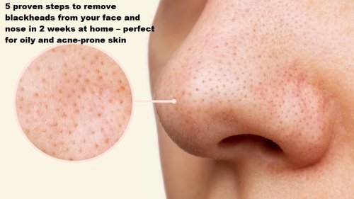 5 proven steps to remove blackheads from your face and nose in 2 weeks at home – perfect for oily and acne-prone skin