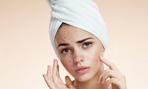 9 Best Oil Control Hacks for Acne-Prone Skin (2025 Guide)